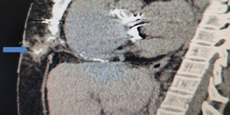 Journal of Clinical Case reports and Images-should pacemaker wires be withdrawn as a whole